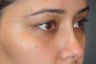 Restylane