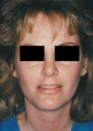 Revision Rhinoplasty