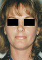 Revision Rhinoplasty