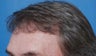 61 year old gentleman treated for alopecia with follicular unit hair transplantation
