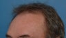 61 year old gentleman treated for alopecia with follicular unit hair transplantation