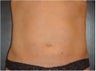 SmartLipo MPX