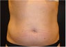 SmartLipo MPX