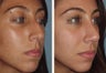 Female Primary Rhinoplasty