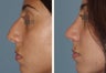 Female Primary Rhinoplasty