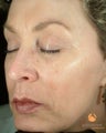 Patient Treated with BOTOX® Cosmetic & Restylane®