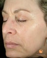 Patient Treated with BOTOX® Cosmetic & Restylane®