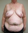 61-year-old female with bilateral immediate DIEP flap breast reconstruction