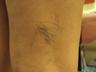 Sclerotherapy