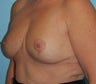 Explant (Removal of Breast Implants) with Breast Lift