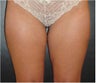 SmartLipo MPX