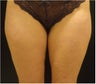 SmartLipo MPX