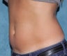 Coolsculpting