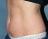 Coolsculpting