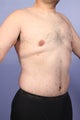 37 yr old weight loss patient