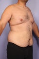 37 yr old weight loss patient