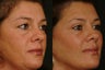 Upper and Lower Blepharoplasty