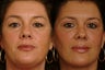Upper and Lower Blepharoplasty