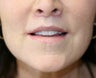 Lip Lift and Corner of Lip Lift