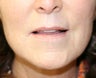 Lip Lift and Corner of Lip Lift