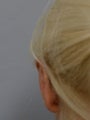Otoplasty