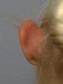 Otoplasty