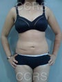 VASER Lipo - 25 yrs. old female (abdomen, back, flanks & thighs)