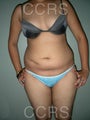 VASER Lipo - 25 yrs. old female (abdomen, back, flanks & thighs)
