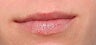 Vascular lesion and photoaging on lips treated with IPL