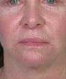 Bullhorn Subnasale Lip Lift