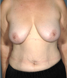 45 year old woman who underwent vertical scar mastopexy and tummy tuck