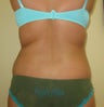 Liposuction of Back, Buttocks and Thighs