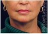Facelift