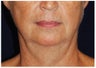 Facelift