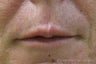 Juvederm®