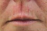 Juvederm®