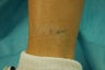 Ankle Tattoo, before, 4 treatments and 11 treatments with 1064 MedLite YAG Laser