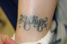 Ankle Tattoo, before, 4 treatments and 11 treatments with 1064 MedLite YAG Laser