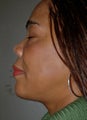 Chin Surgery, Chin Augmentation, Double Chin