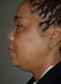 Chin Surgery, Chin Augmentation, Double Chin