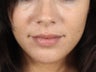 Natural looking lip injections