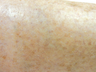 Surface Ohmic Thermolysis with Thermal Heat for Spider Veins