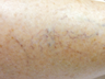 Surface Ohmic Thermolysis with Thermal Heat for Spider Veins