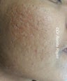 Acne scars after needle radiofrequency resurfacing
