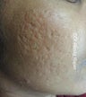 Acne scars after needle radiofrequency resurfacing