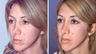 Severely Over-Resected Rhinoplasty Is Corrected