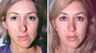 Severely Over-Resected Rhinoplasty Is Corrected