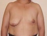 Breast Lift
