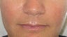 39 year old undergoing fillers to her nasolabial folds