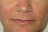 39 year old undergoing fillers to her nasolabial folds